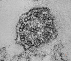 F,5y. | immotile cilia syndrome - nasal mucosa